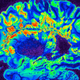 A brain scan of someone with multiple sclerosis